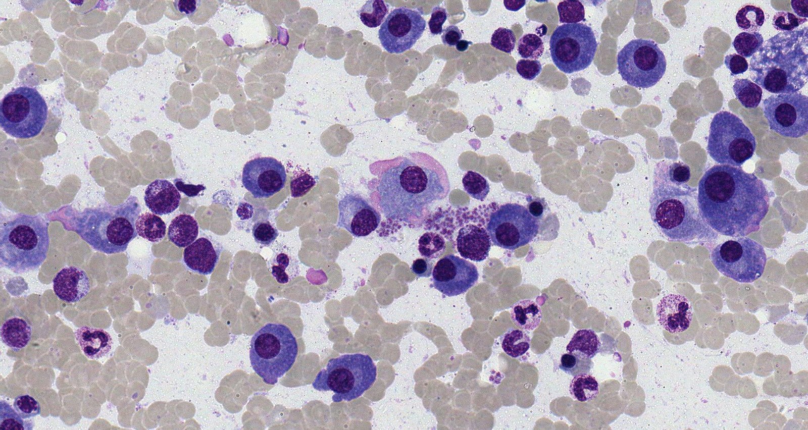 Multiple myeloma (bone marrow smear)