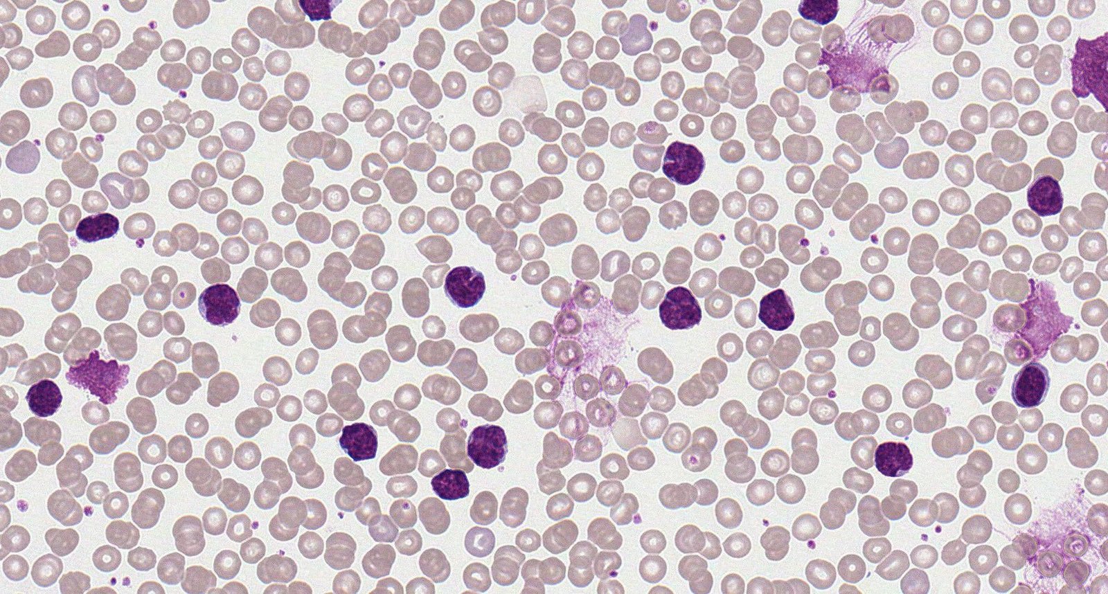 Mantle cell lymphoma (peripheral blood smear)