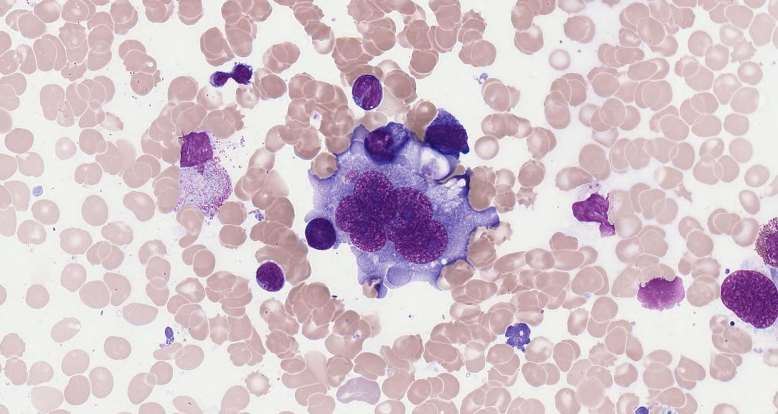 Hodgkin lymphoma (bone marrow smear)