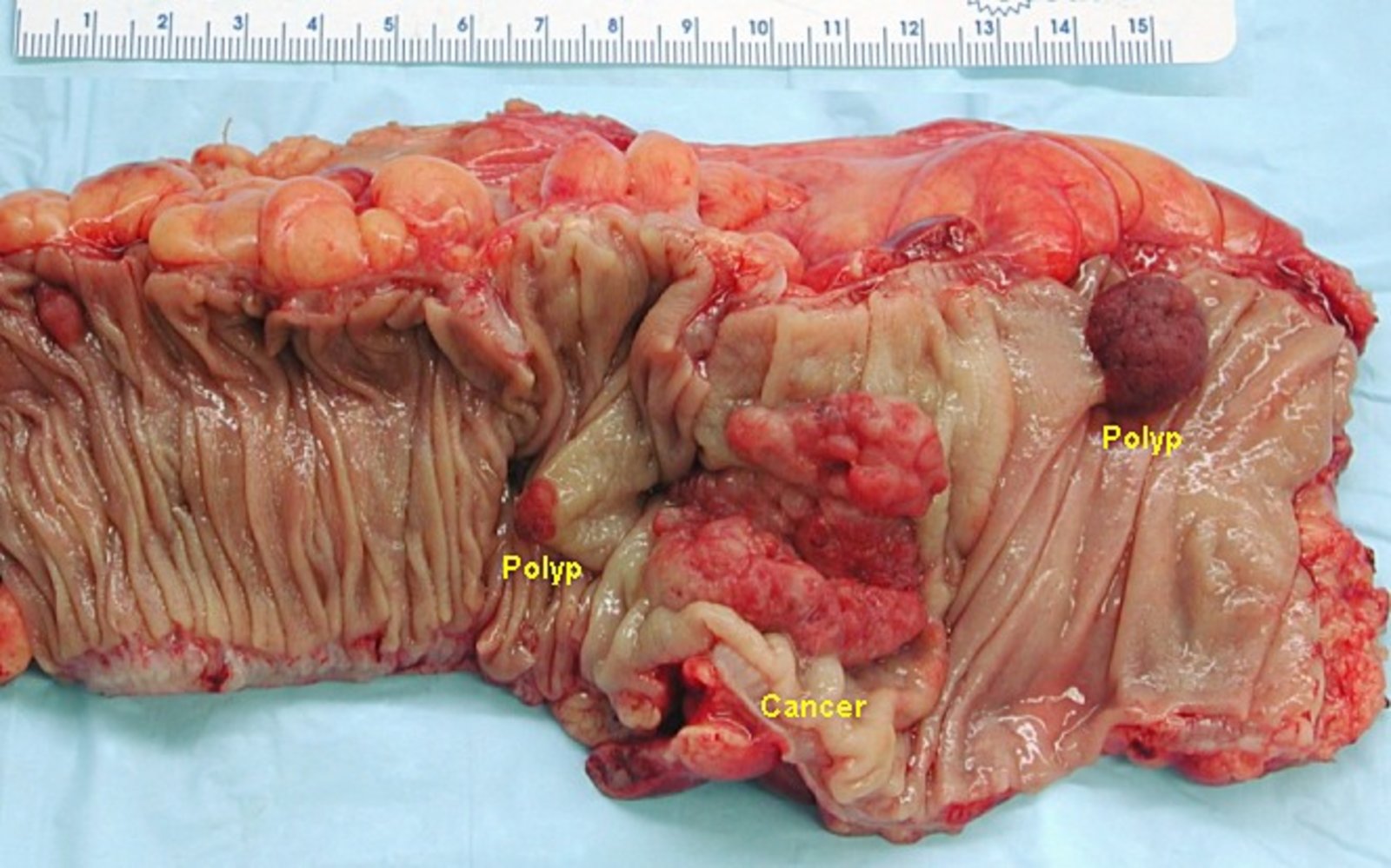Colorectal carcinoma and adenomatous polyps