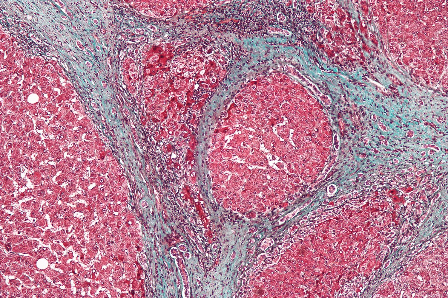 Histopathology of liver cirrhosis