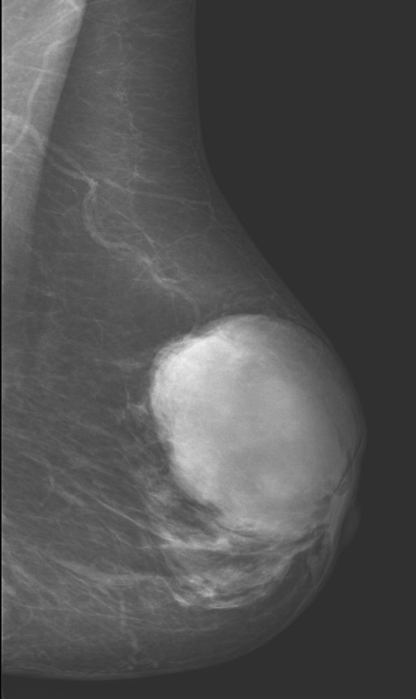 Large breast mass