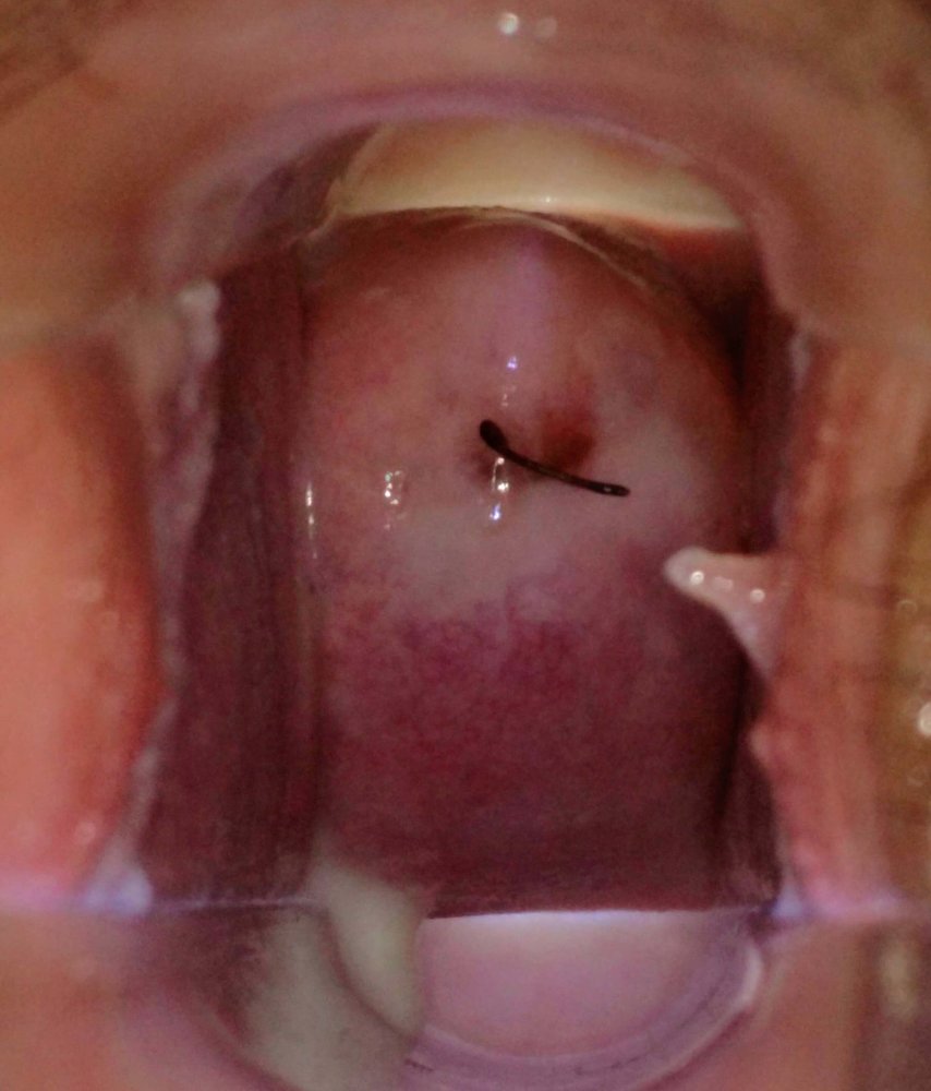 Medical speculum examination of the vagina