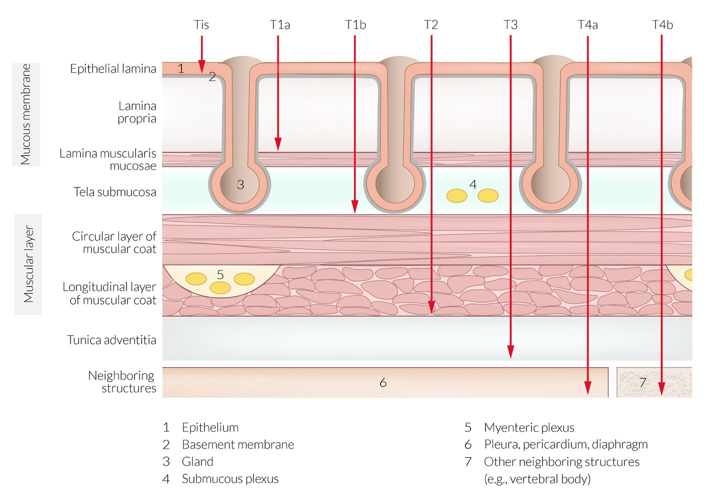 Esophageal cancer