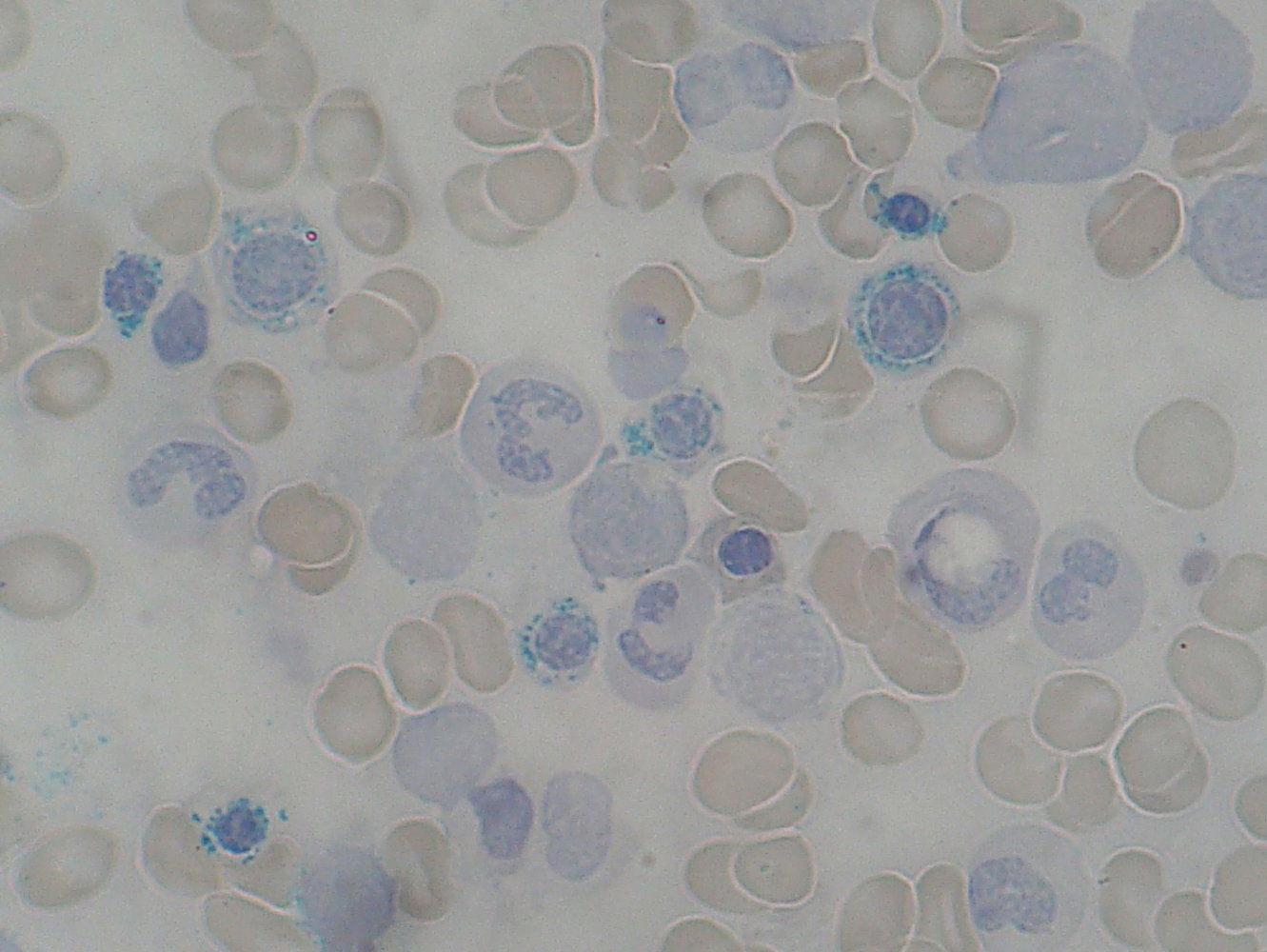 Sideroblasts