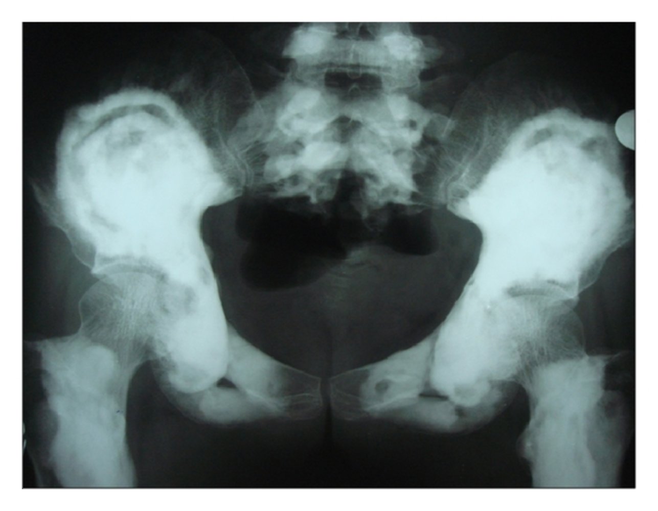 Osteopetrosis
