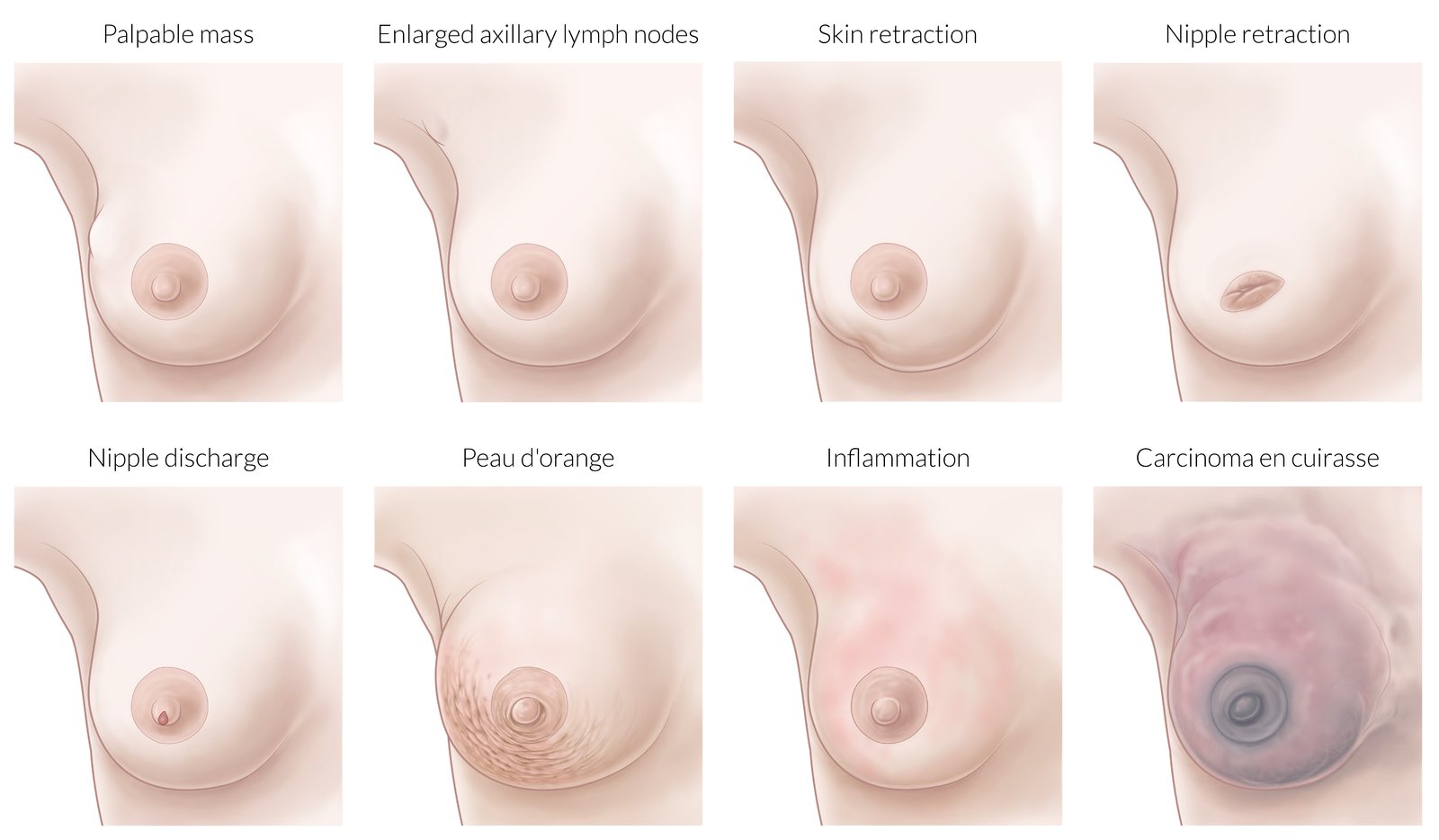 Local findings in breast cancer