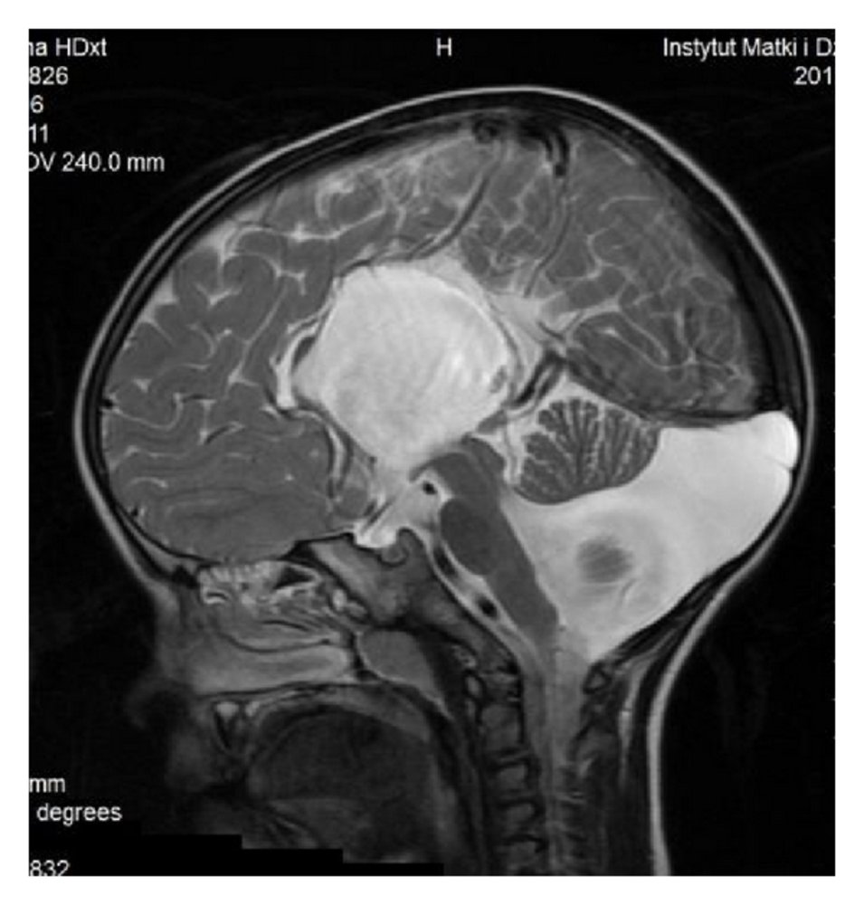 Dandy-Walker syndrome