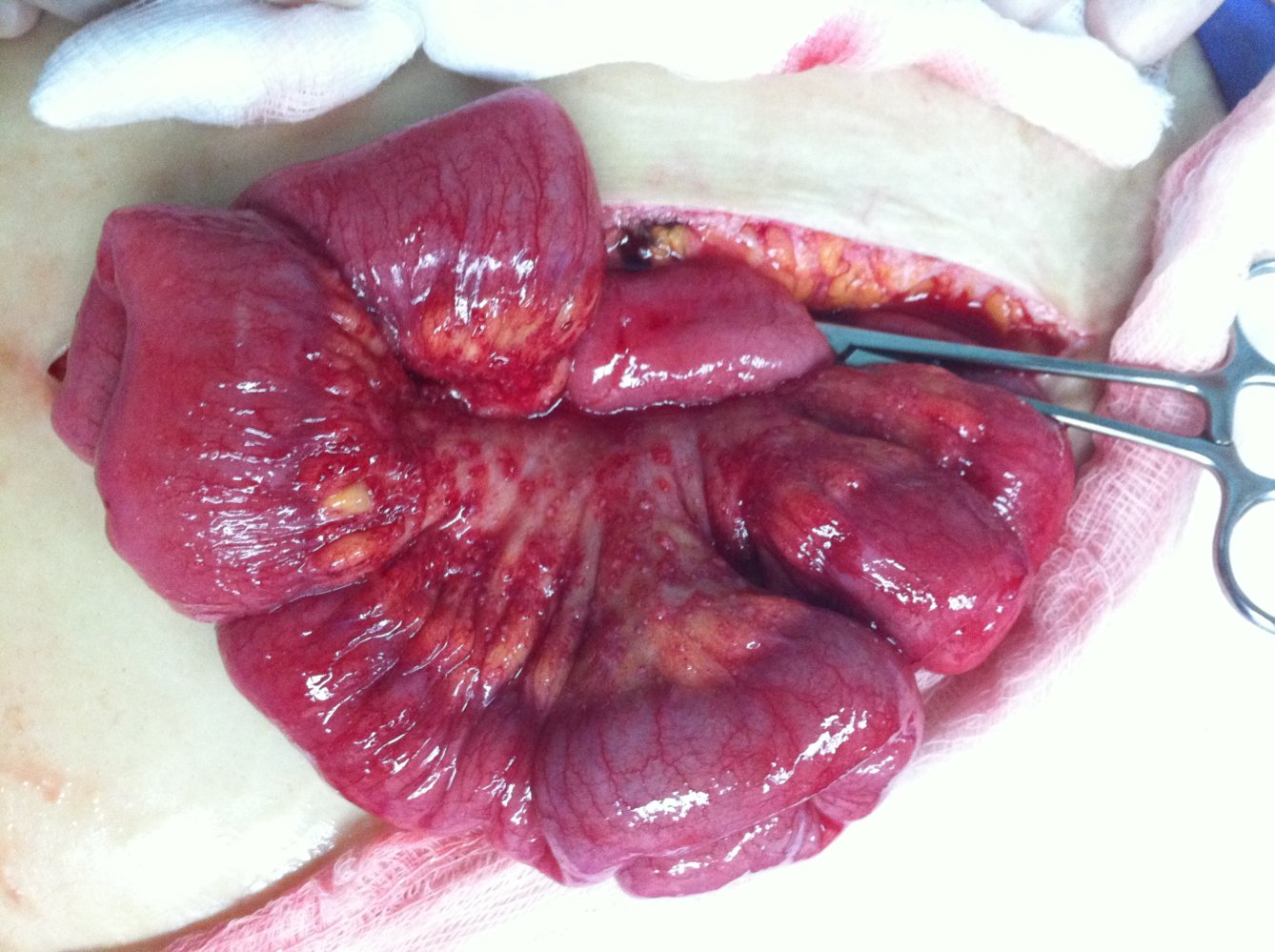 Peritoneal carcinomatosis