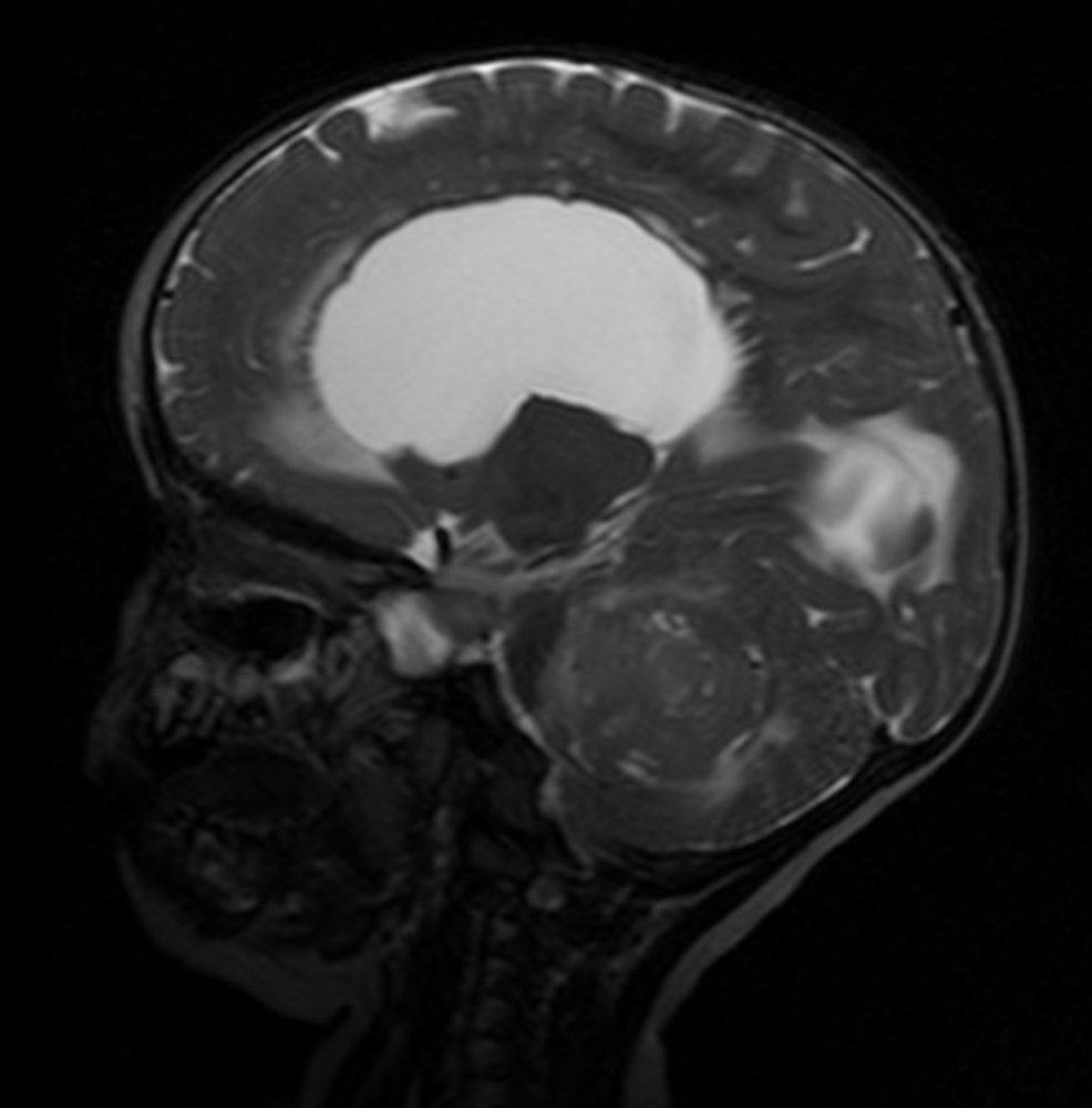 Medulloblastoma