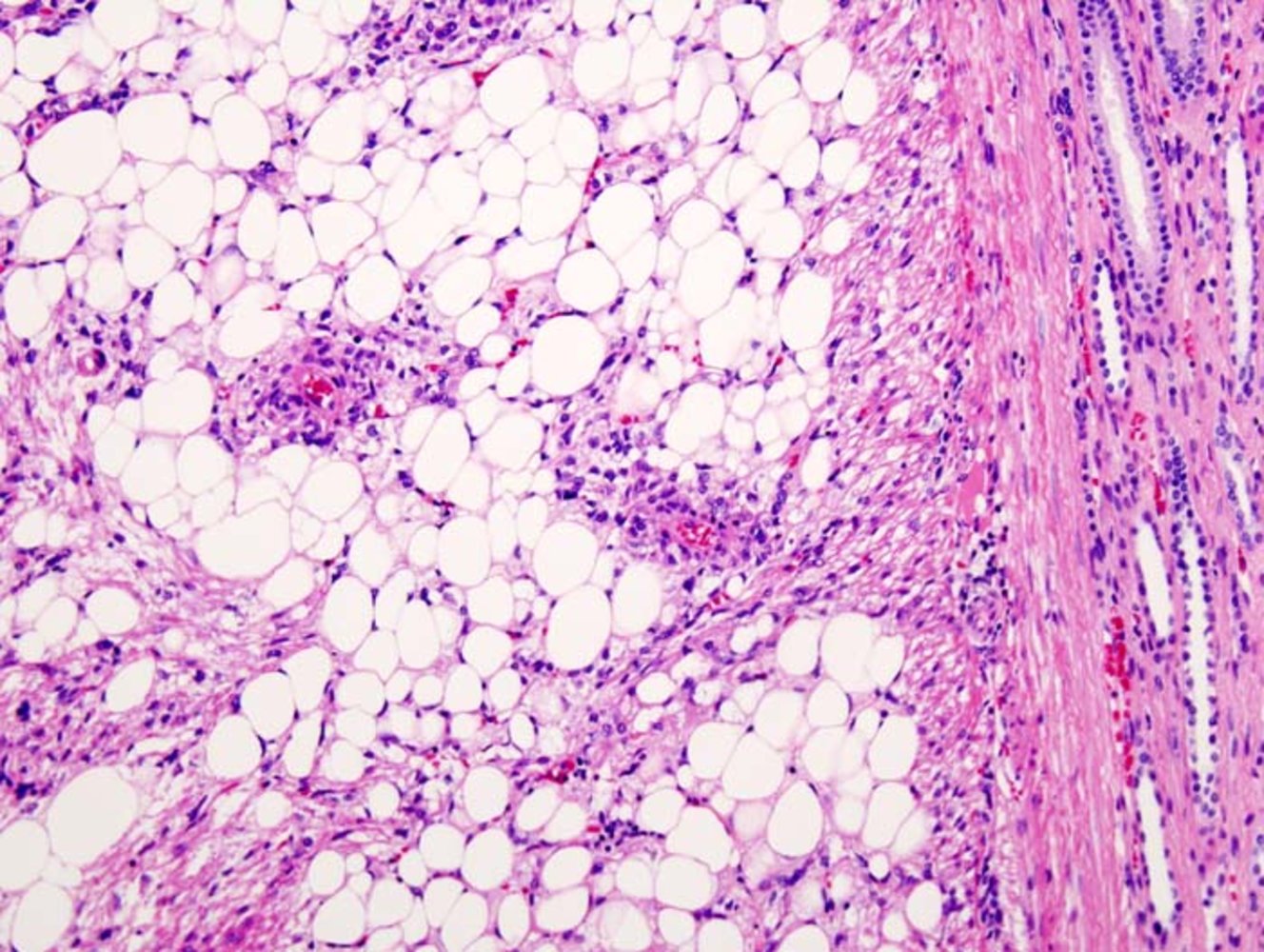 Angiomyolipoma
