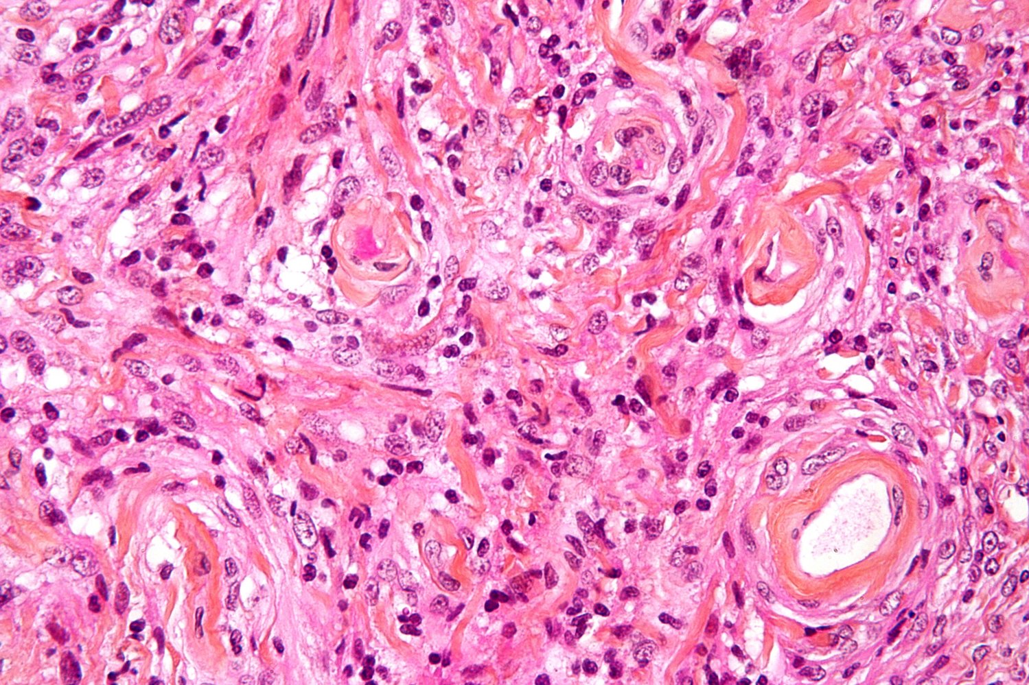 Meningioma