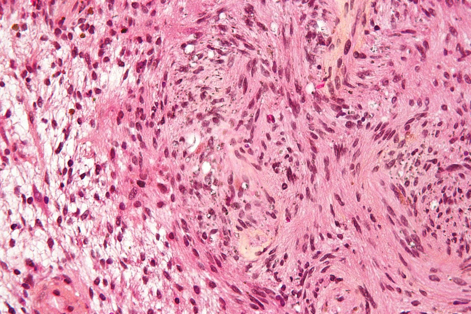 Schwannoma (neurilemoma)