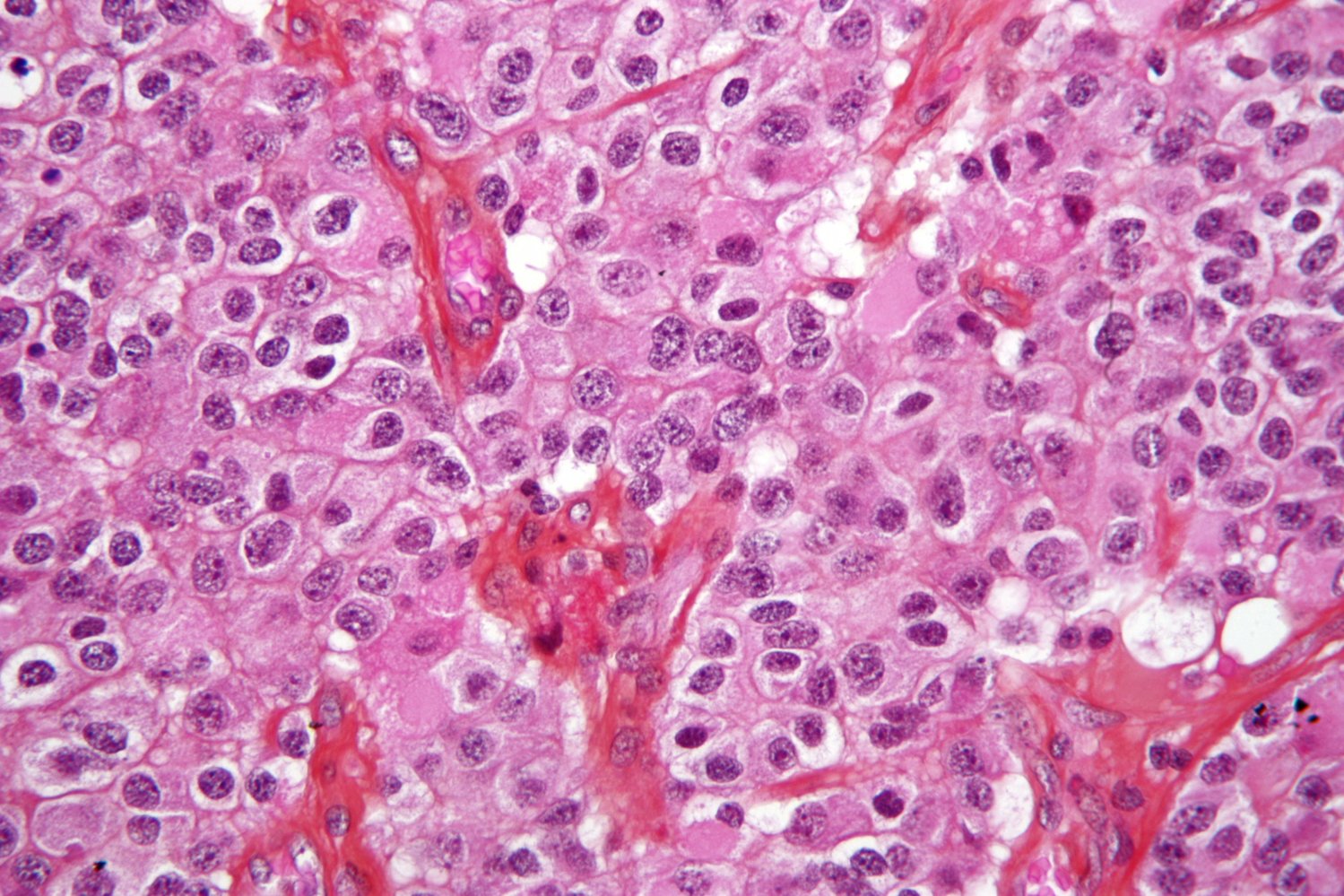 Oligodendroglioma