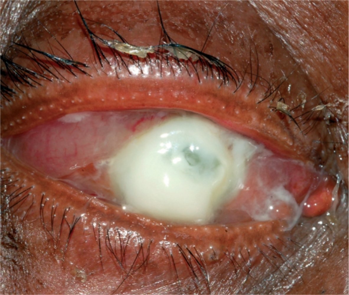 Corneal necrosis in bacterial keratitis