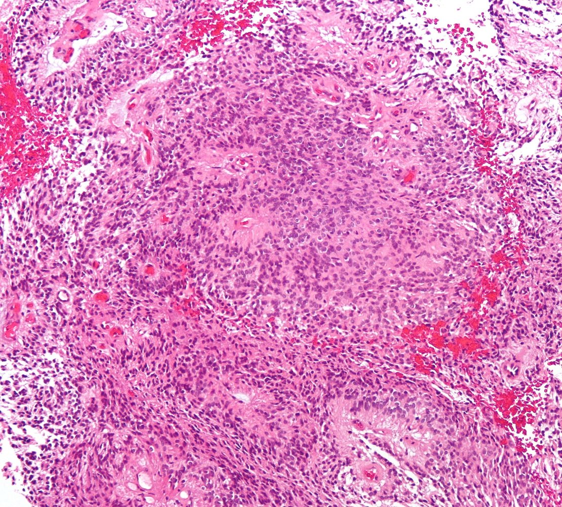 Ependymoma