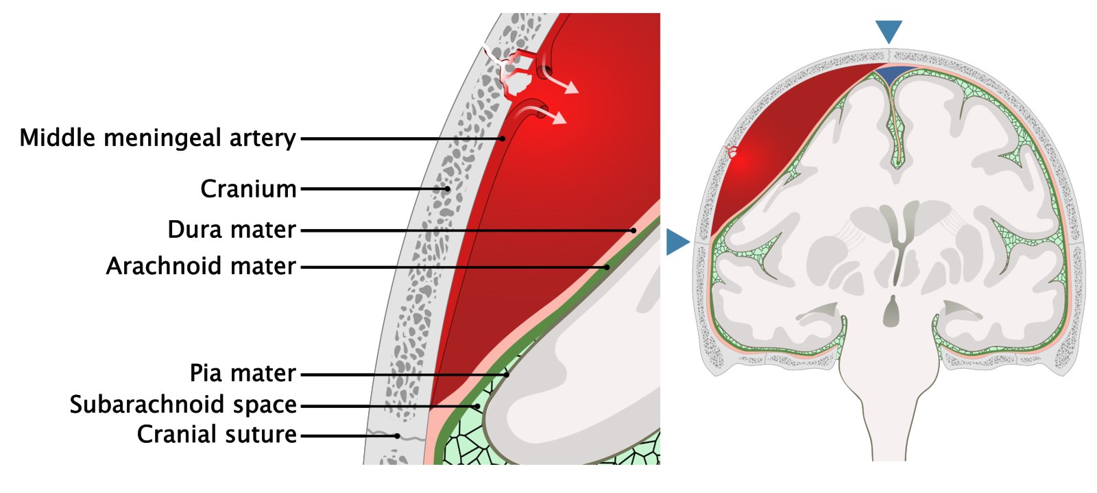 Pathophysiology of an epidural hematoma