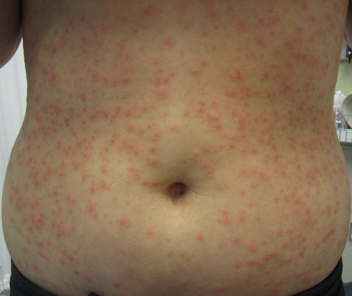 Pseudomonas folliculitis
