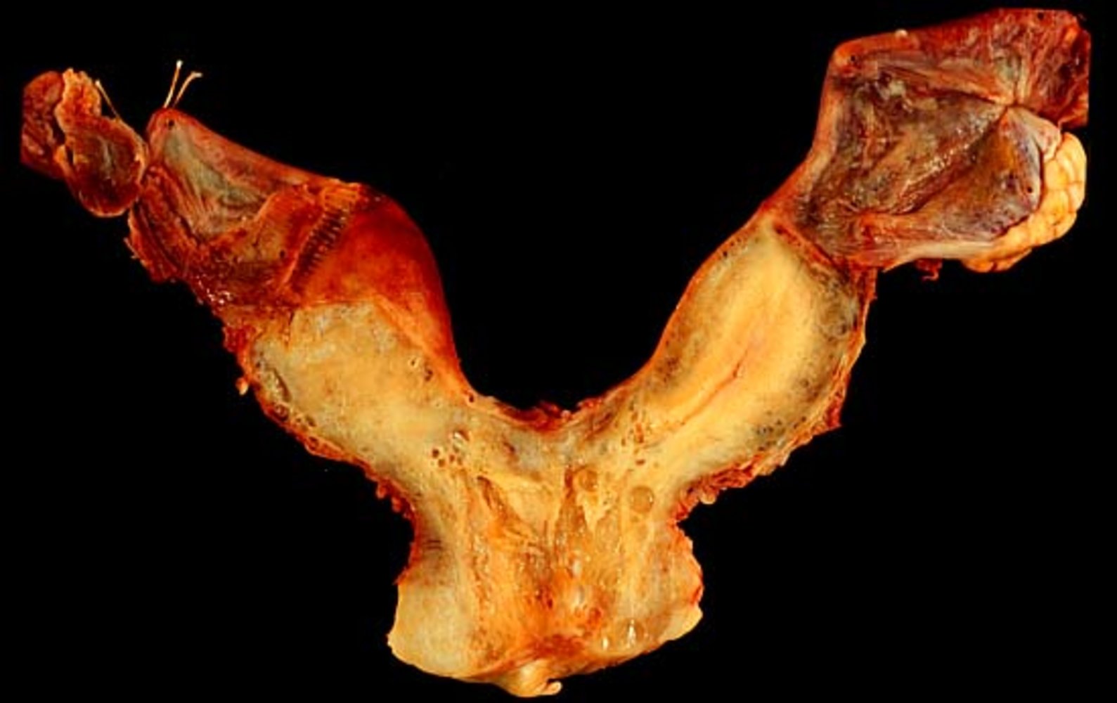 Bicornuate uterus