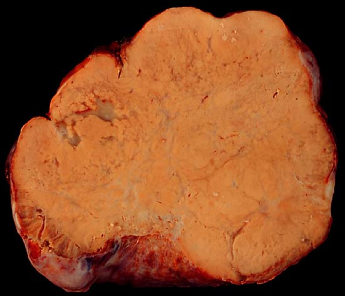 Krukenberg tumor