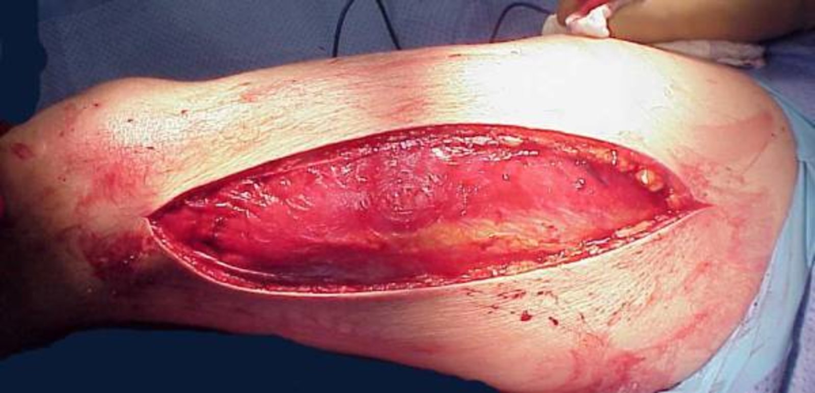 Fasciotomy