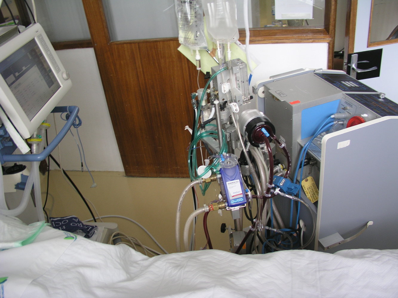 Extracorporeal membrane oxygenation (ECMO)