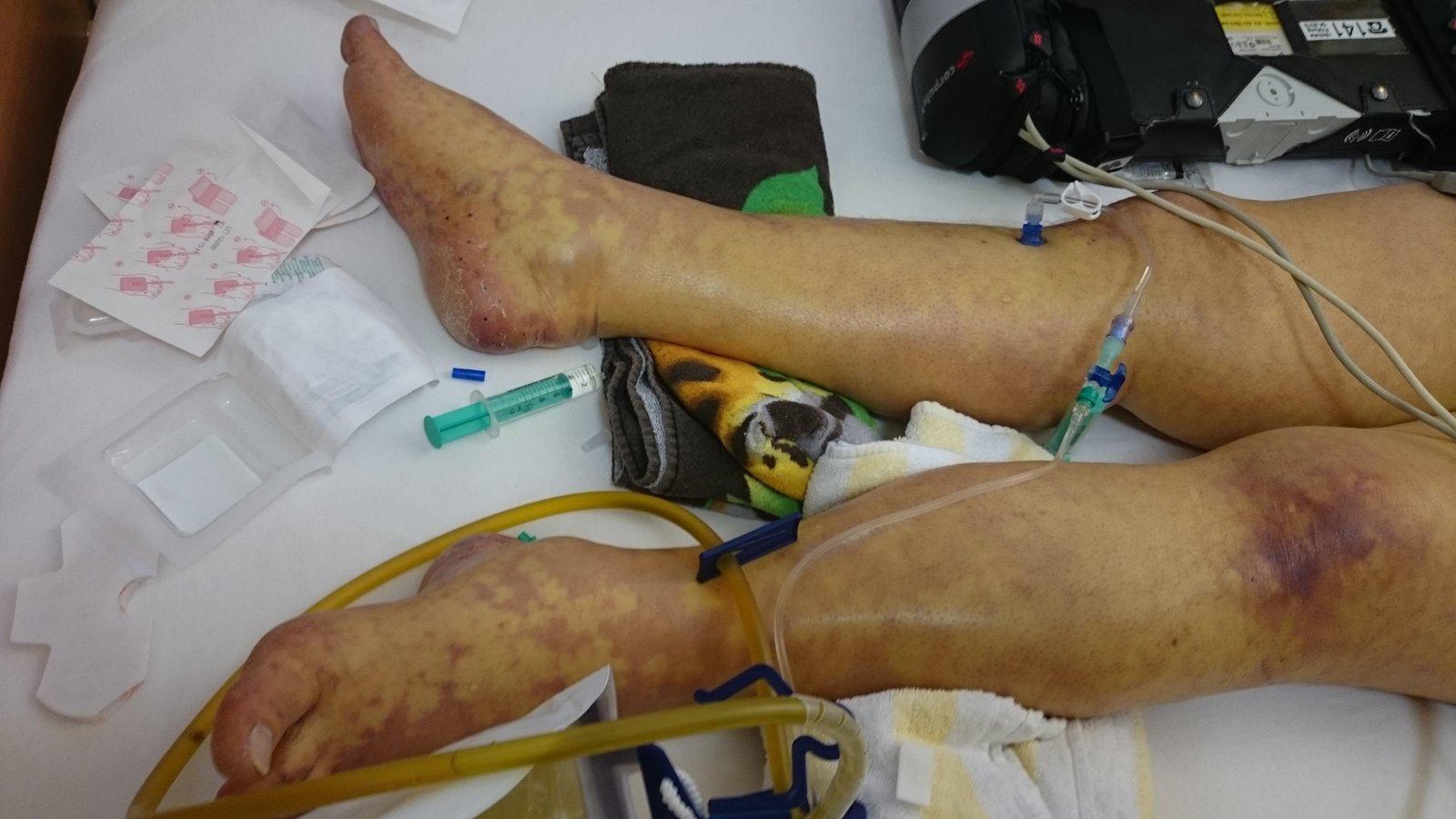 Skin changes in septic shock