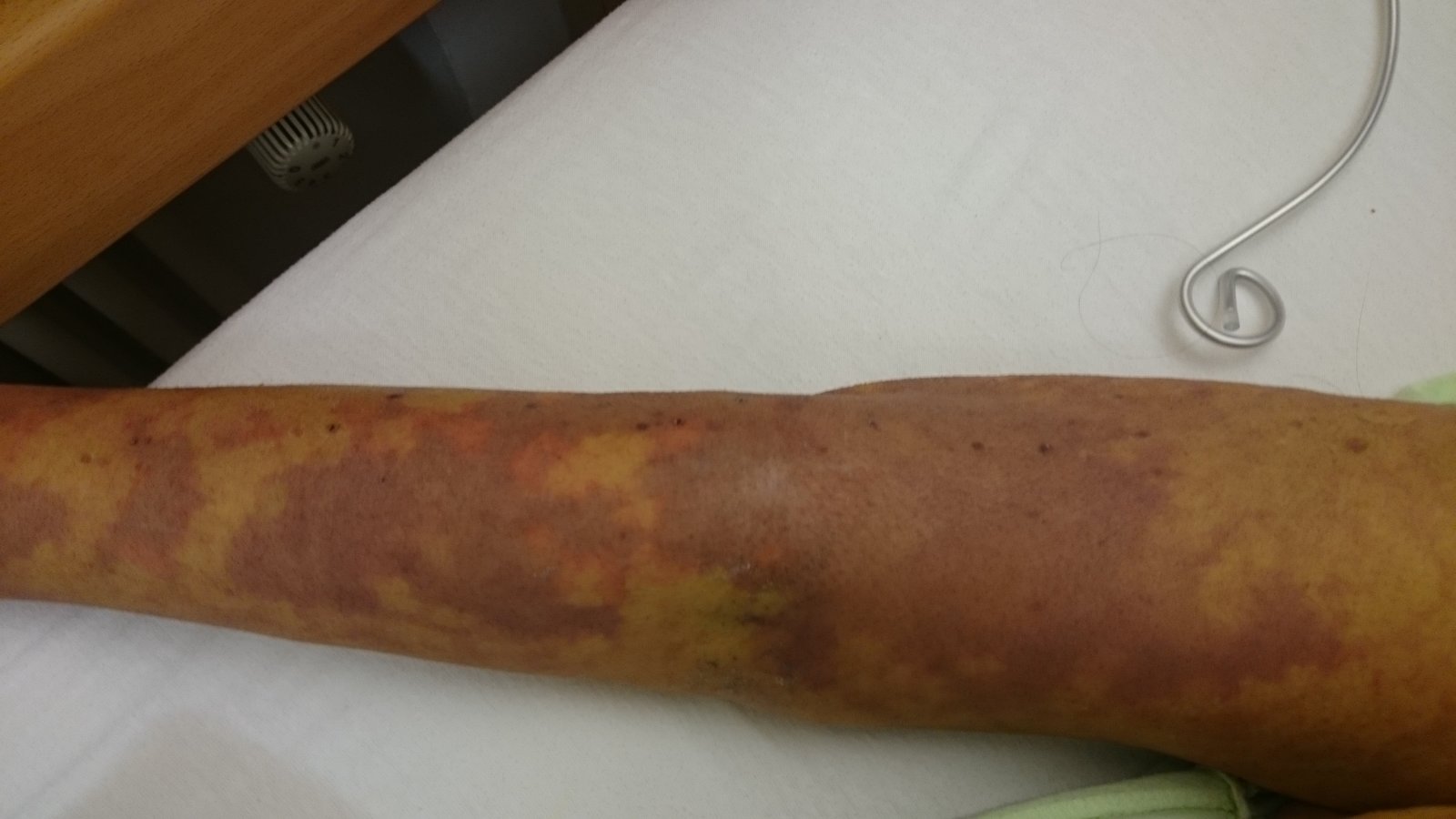 Skin changes in septic shock