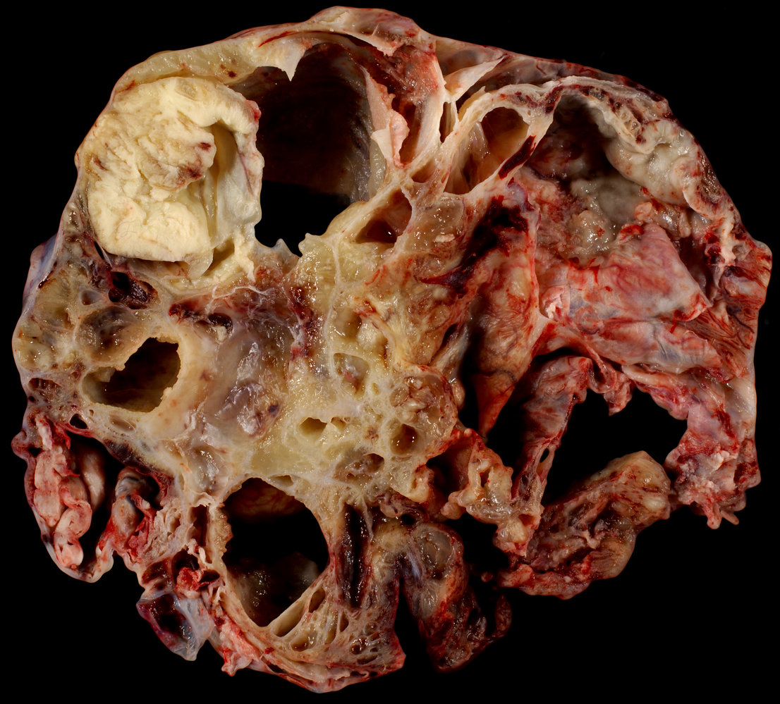 Mucinous cystadenocarcinoma of the ovary