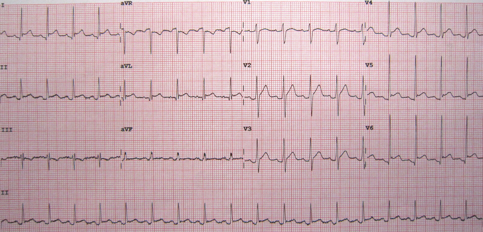 Acute pericarditis