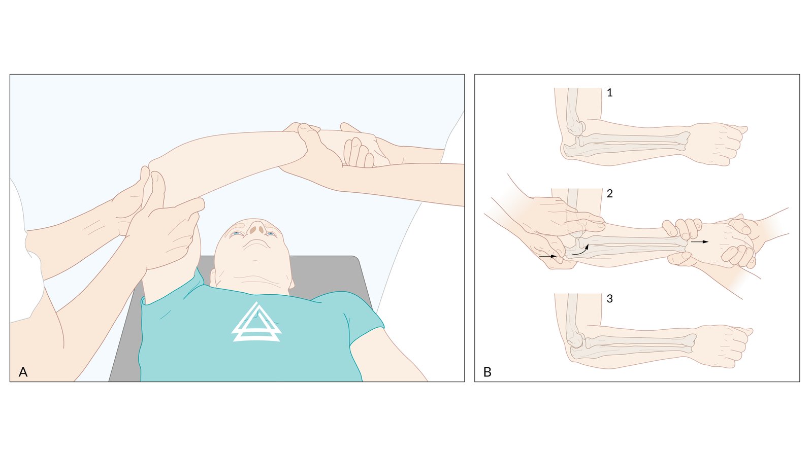 Closed reduction of uncomplicated elbow dislocation