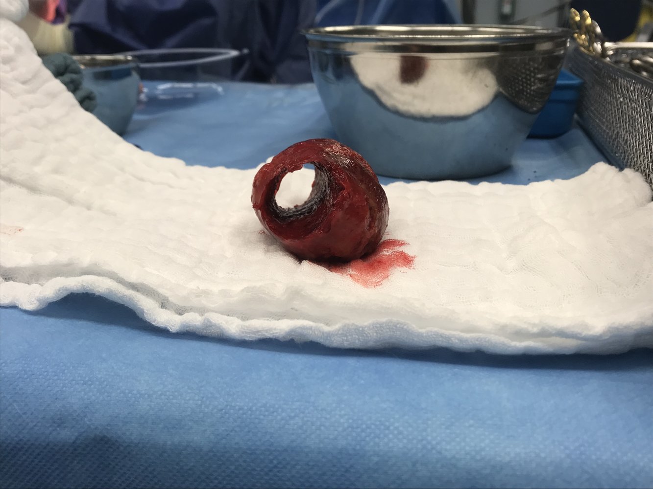 Thrombus from an abdominal aortic aneurysm