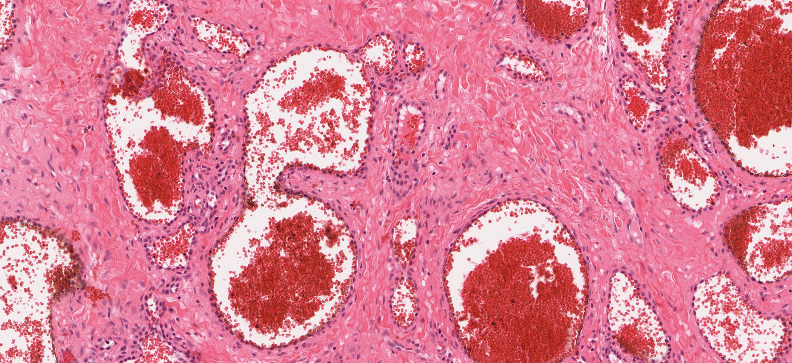 Capillary hemangioma of the skin (cherry angioma)