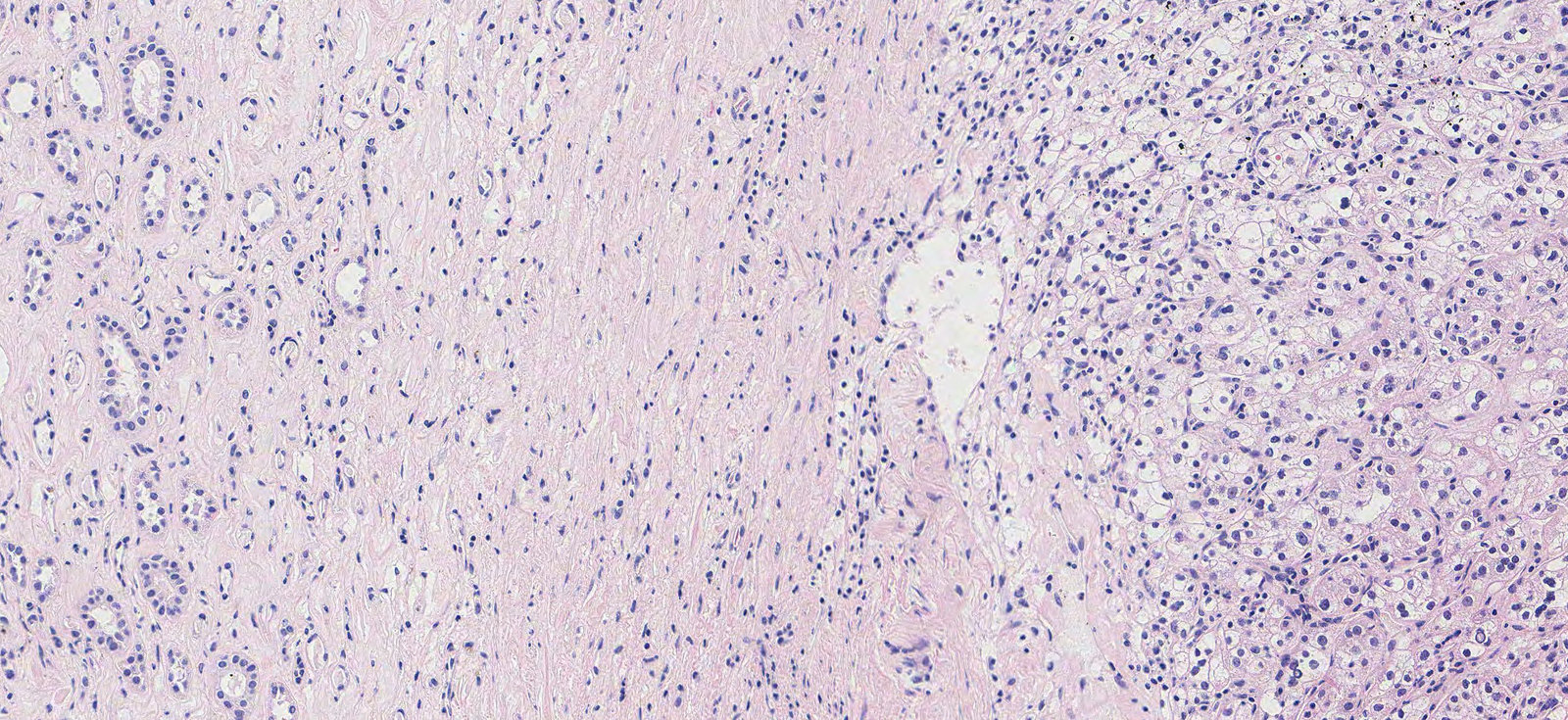 Clear cell renal cell carcinoma