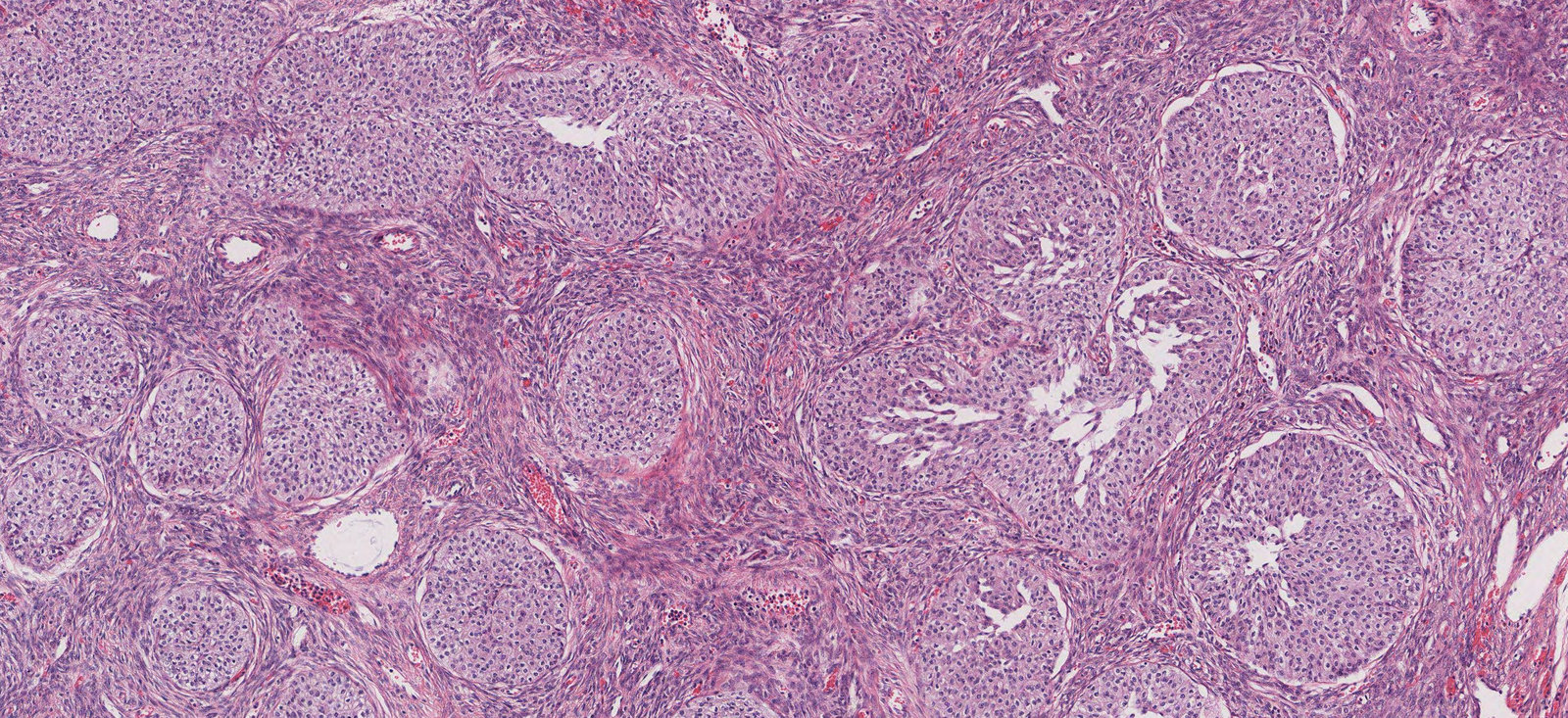 Brenner tumor