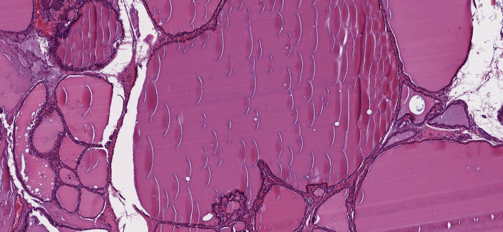 Nodular goiter
