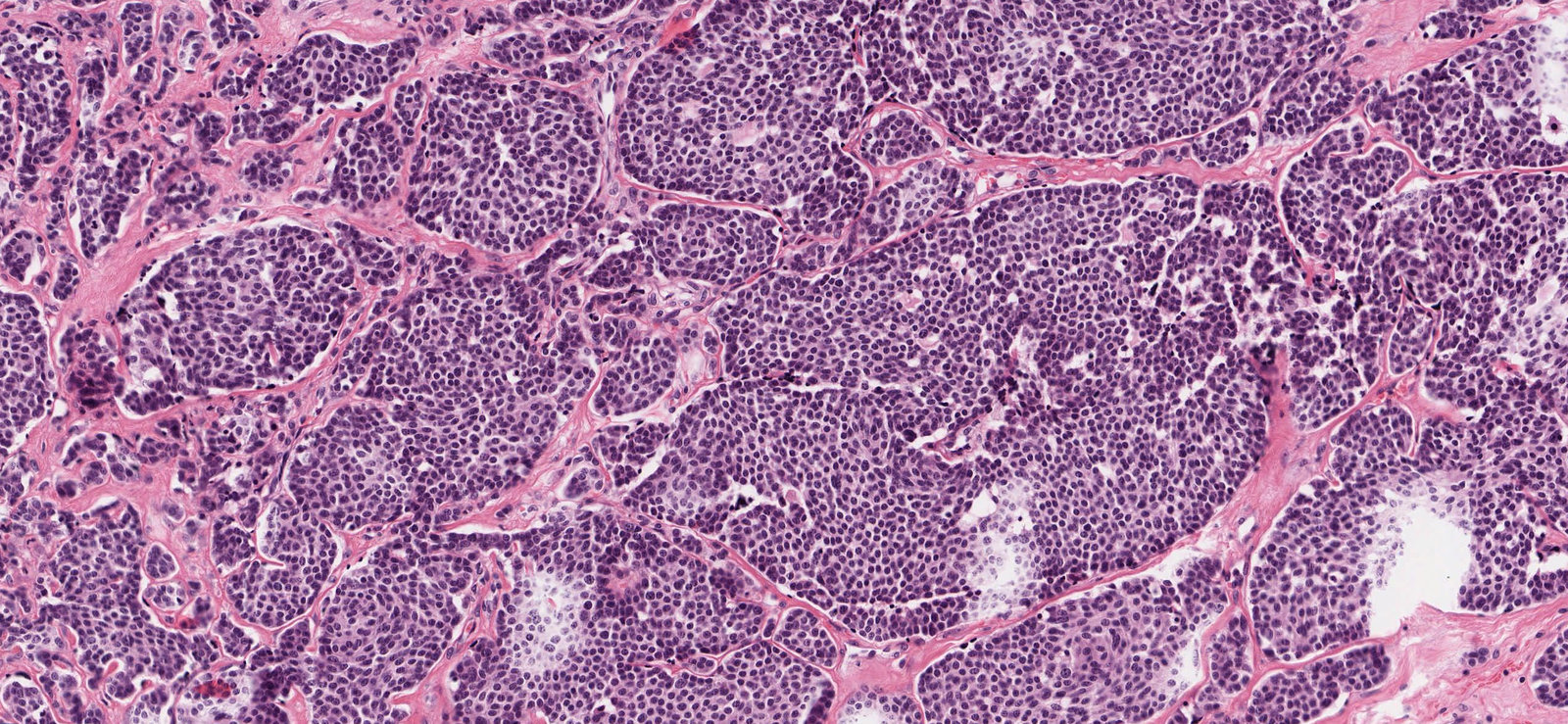 Medullary thyroid carcinoma