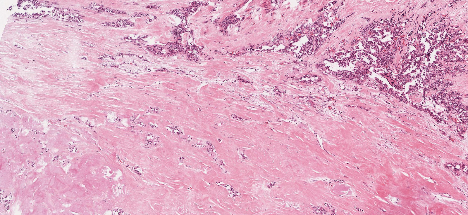 Amyloid deposits in medullary thyroid carcinoma