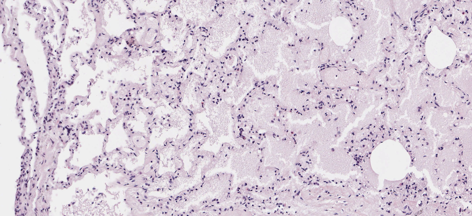 Pulmonary alveolar edema