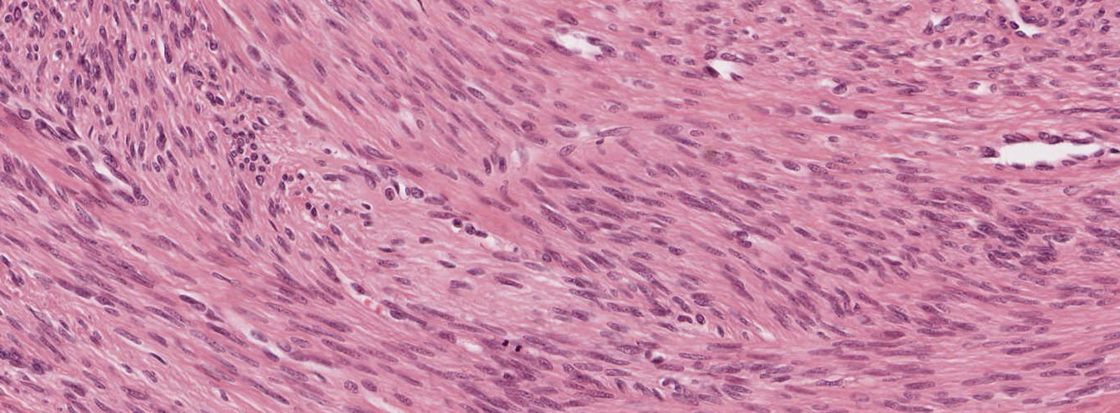 Leiomyoma