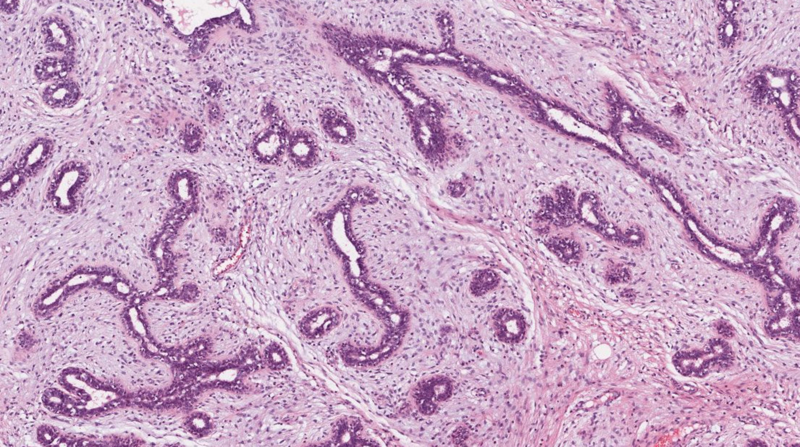 Fibroadenoma of the breast