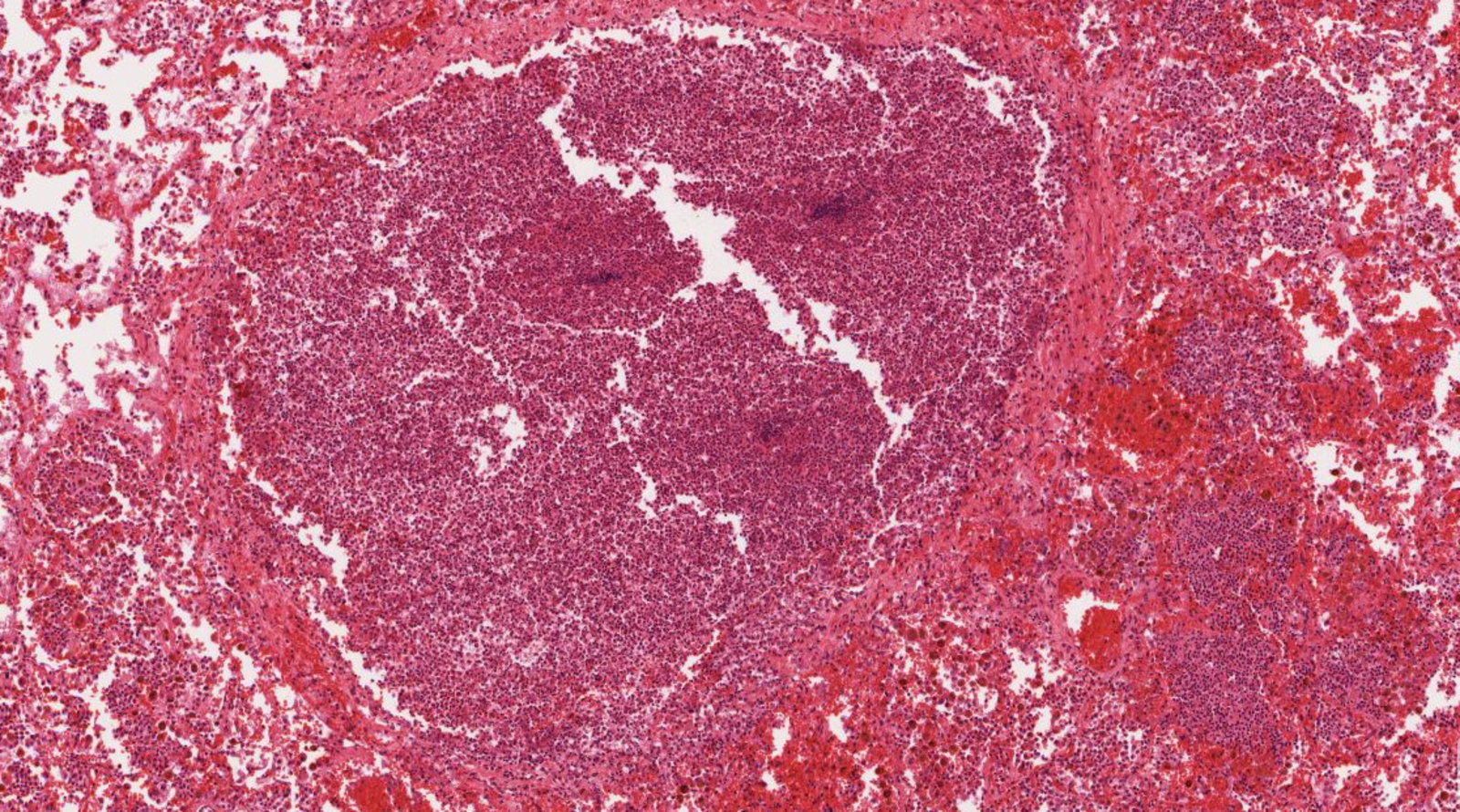 Bronchopneumonia