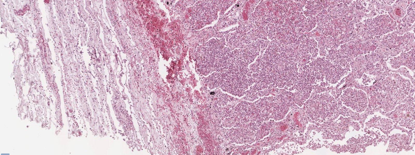 Lobar pneumonia