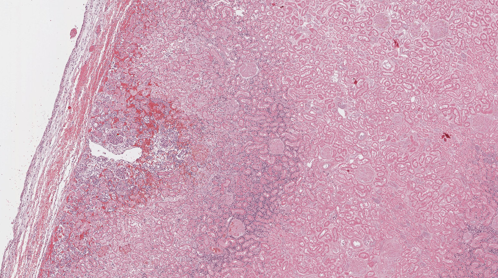 Coagulative necrosis in renal infarction