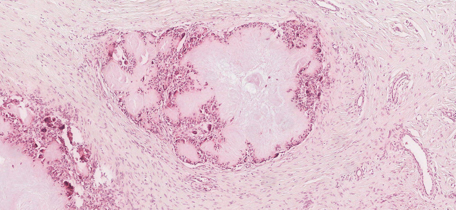 Gout tophus with foreign body granulomas