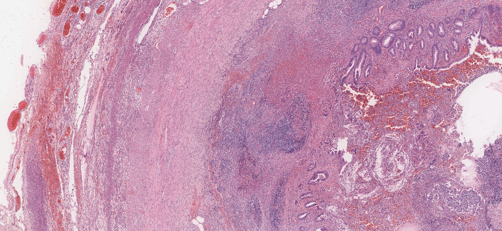 Appendicitis with ulceration