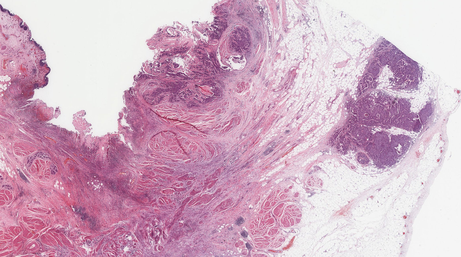 Urothelial carcinoma of the bladder (transitional cell carcinoma)