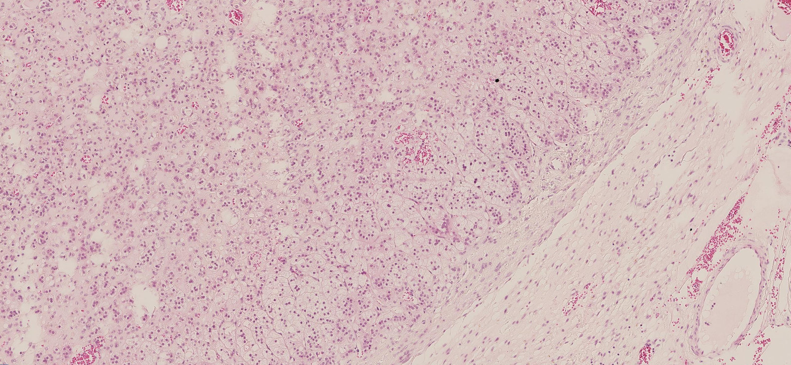 Adrenal adenoma