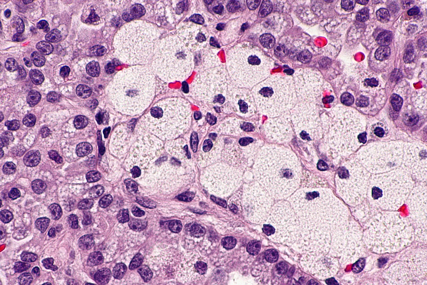 Papillary renal cell carcinoma type 2