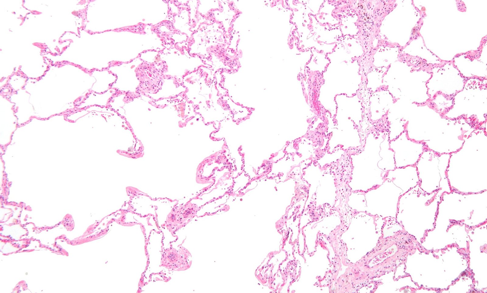 Pulmonary emphysema